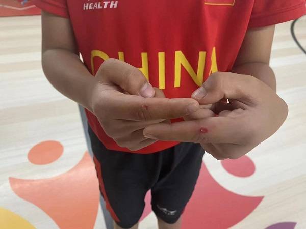 甩到腿上,背上,手上,会打到皮肤红肿,甚至是破皮流血