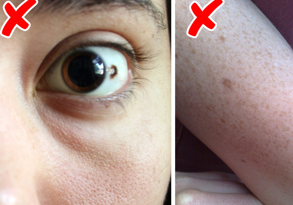 关于痣的9个错误危险知识,甚至有些医生也相信