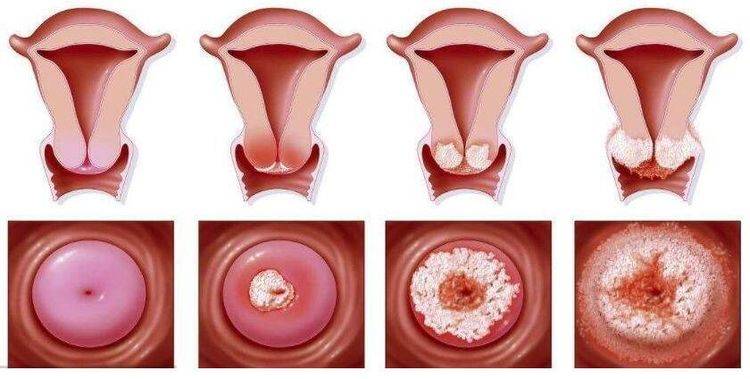 子宫内膜癌的早期症状图片