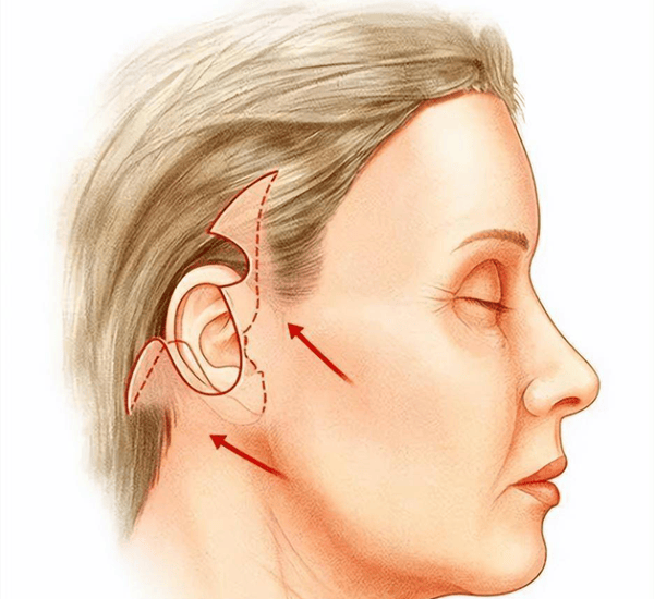 求实:筋膜悬吊提升术是什么,做了悬吊手术要休息多久