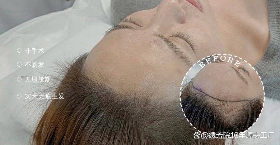 科技重塑发际线,告别脱发烦恼——绒毛发际线