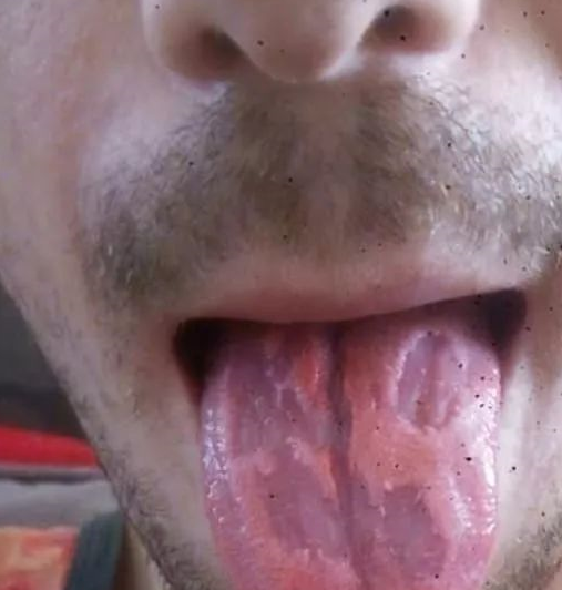 舌头底部长了小肉疙瘩图片
