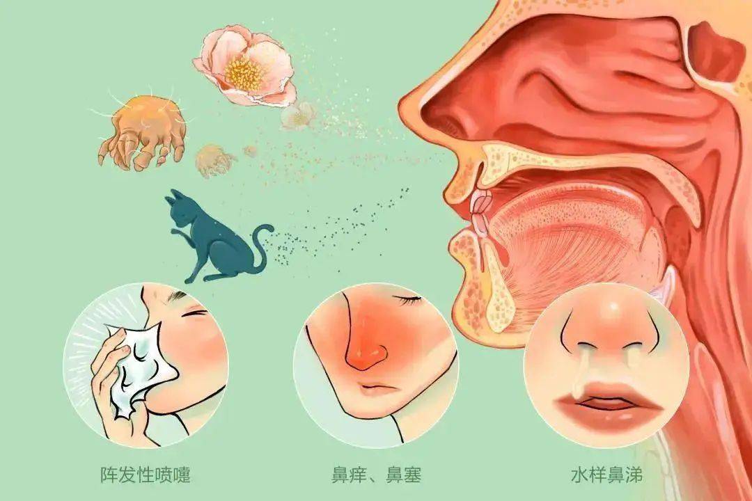 逸青糠酸莫米松鼻喷雾剂:治鼻炎最厉害的办法,鼻塞