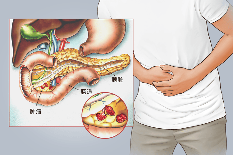 胰腺不好的6大征兆图片