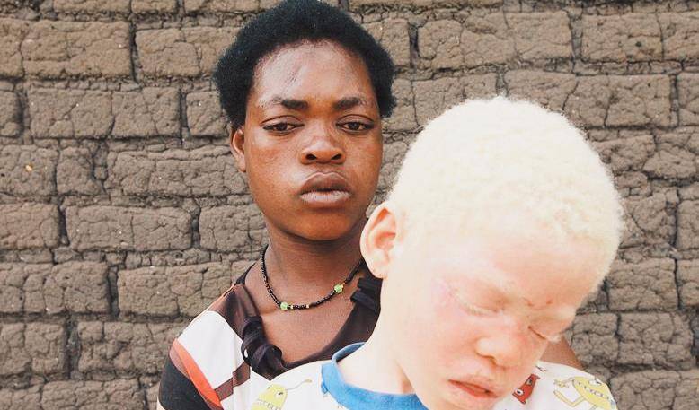 非洲一群人被当作"唐僧肉",血液堪比黄金,警察24小时重点保护