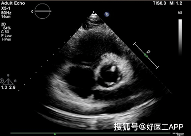 主动脉瓣狭窄