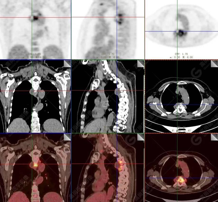 【高尚病例】18f-fdg pet/ct显像应用于骨结核