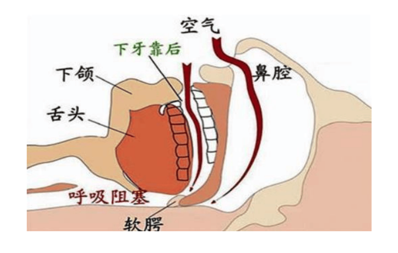 maquet呼吸机连接图图片