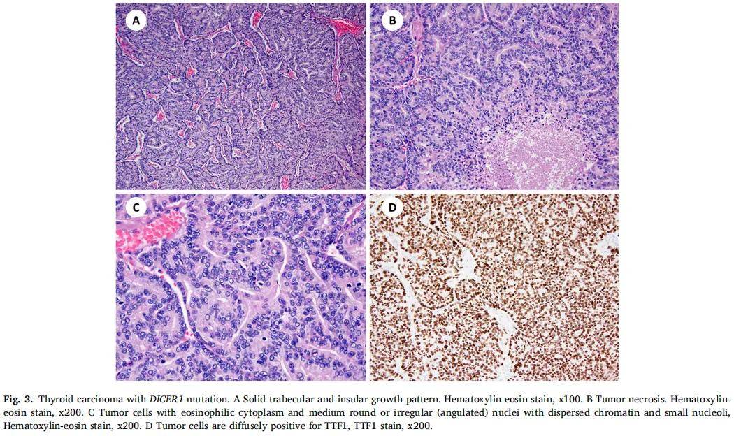 滤泡起源的甲状腺癌ngs检出率超高!