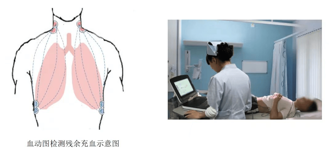 血动图检测操作简便,检测过程安全无创类似心电图只需3