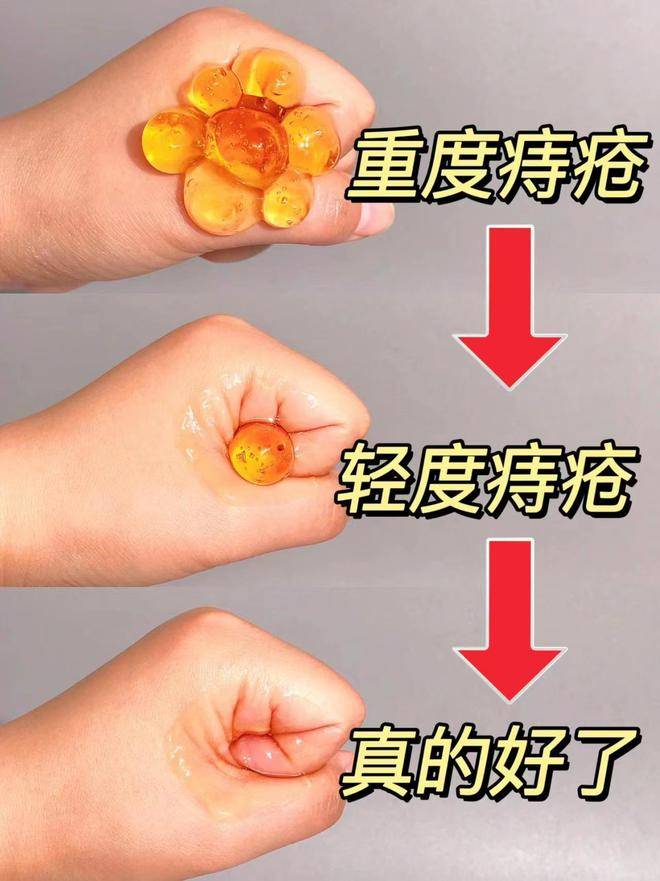 在家也能无痛消肉球!一步到位杜绝复发!