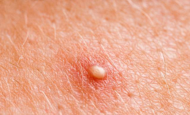 女性私处长痘痘,是染上"性病"了?医生直言:这些异常不要忽略