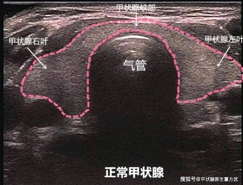 正常甲状腺彩超图片