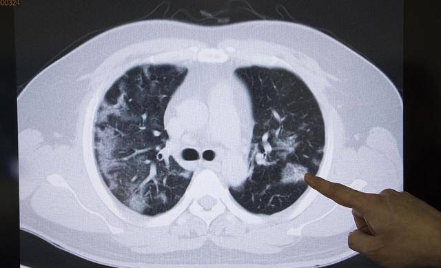 查出肺结节别恐慌,5个应对方法请收好