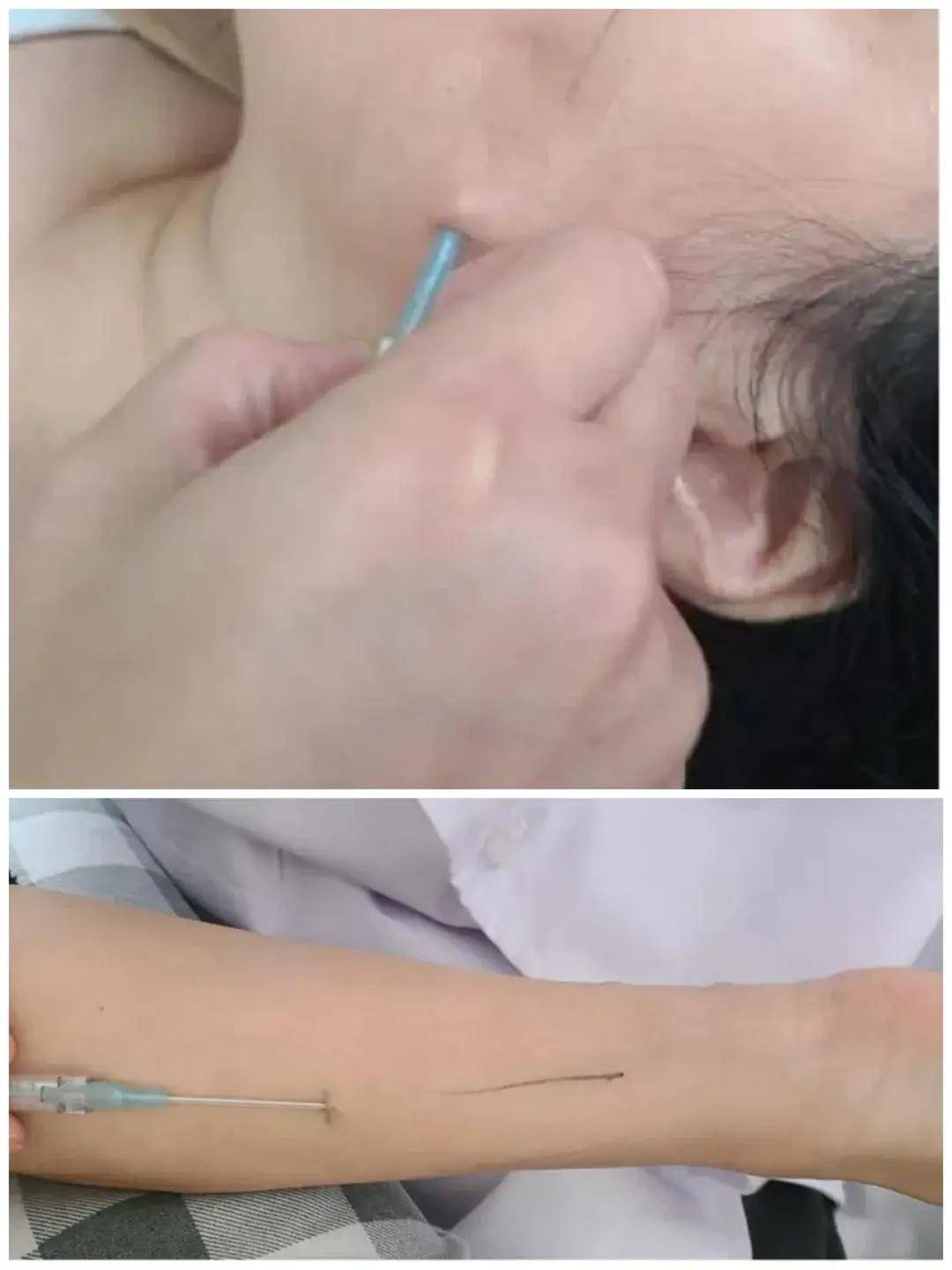 颈椎酸痛又头晕?中医"浮针"解烦忧