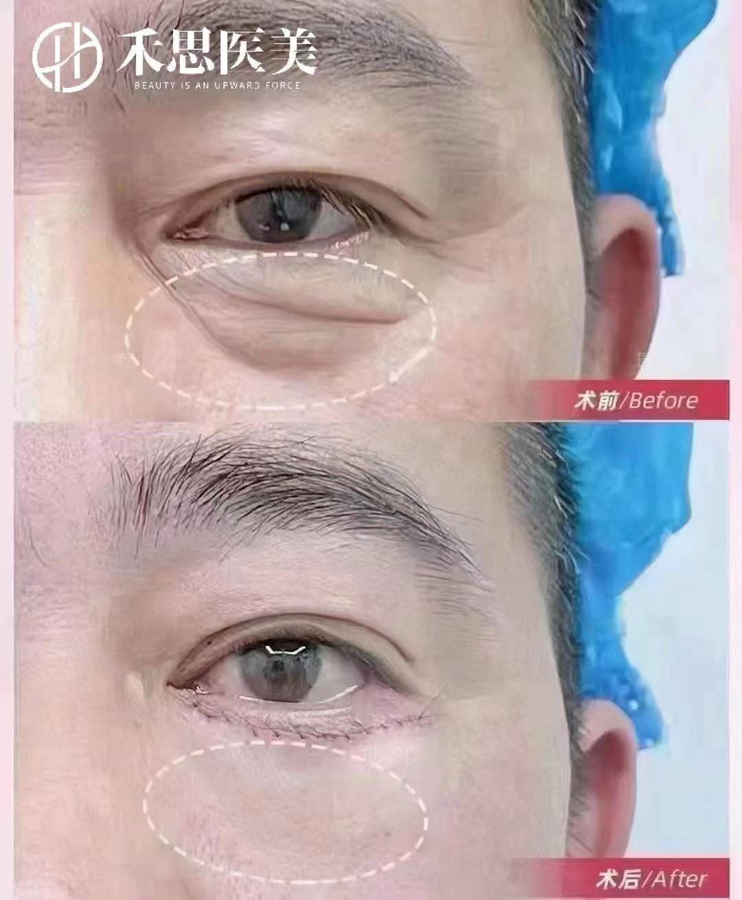 深圳做眼袋费用