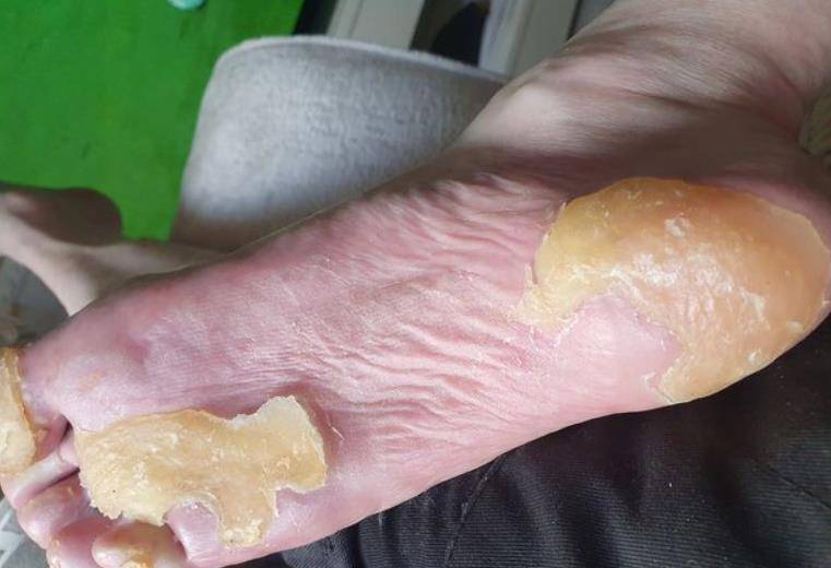 英国男孩身患怪病只能爬着走,脚底长出2.5cm老茧,50年后站了起来