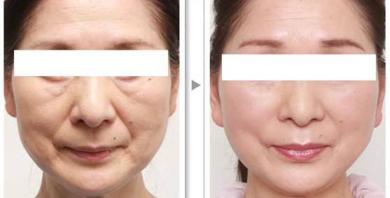 针刀美容,埋线减肥,线雕提升技术班 2024年7月11日.郑州