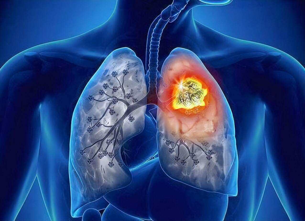 肺癌大多是拖出来的,身体有这3个表现,别轻易忽视了