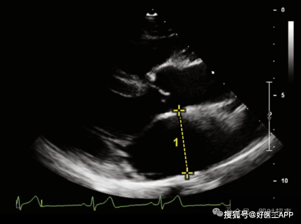 床旁超声心动图的基本测量