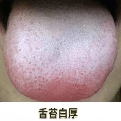 舌苔厚白口臭是什么原因引起的?舌苔白又厚口臭怎么办?