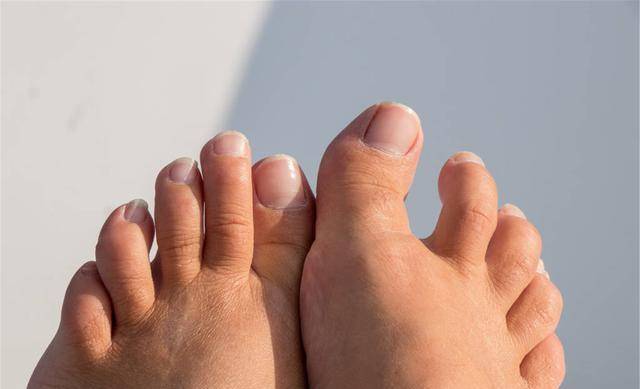 糖尿病足来"报到"时,脚部会先给你4个小提醒,切勿视若无睹