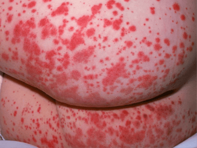 成功救治一例极重型血小板减少性紫癜小患儿的案例