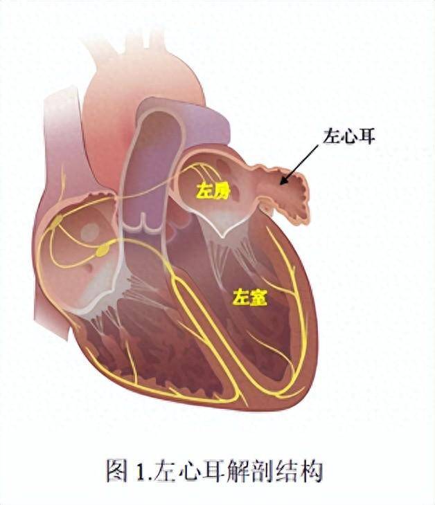 远离"卒"不及防!房颤者卒中"心"选择,左心耳封堵术了解一下