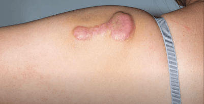 蔡忠廷医学博士: 蟹足肿(keloid scar)的黏连性纤连蛋白疗法!