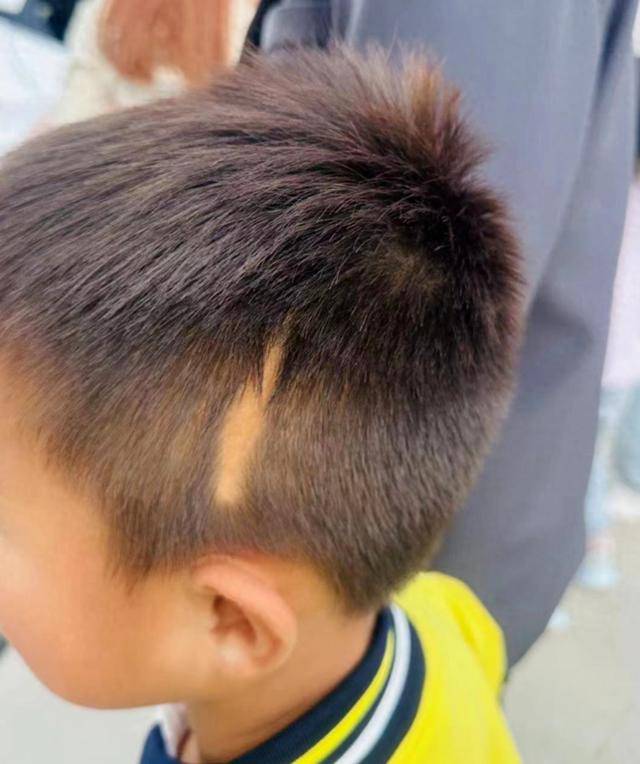留置针导管在婴儿血管里漂移5年-留置针对小孩血管有影响吗