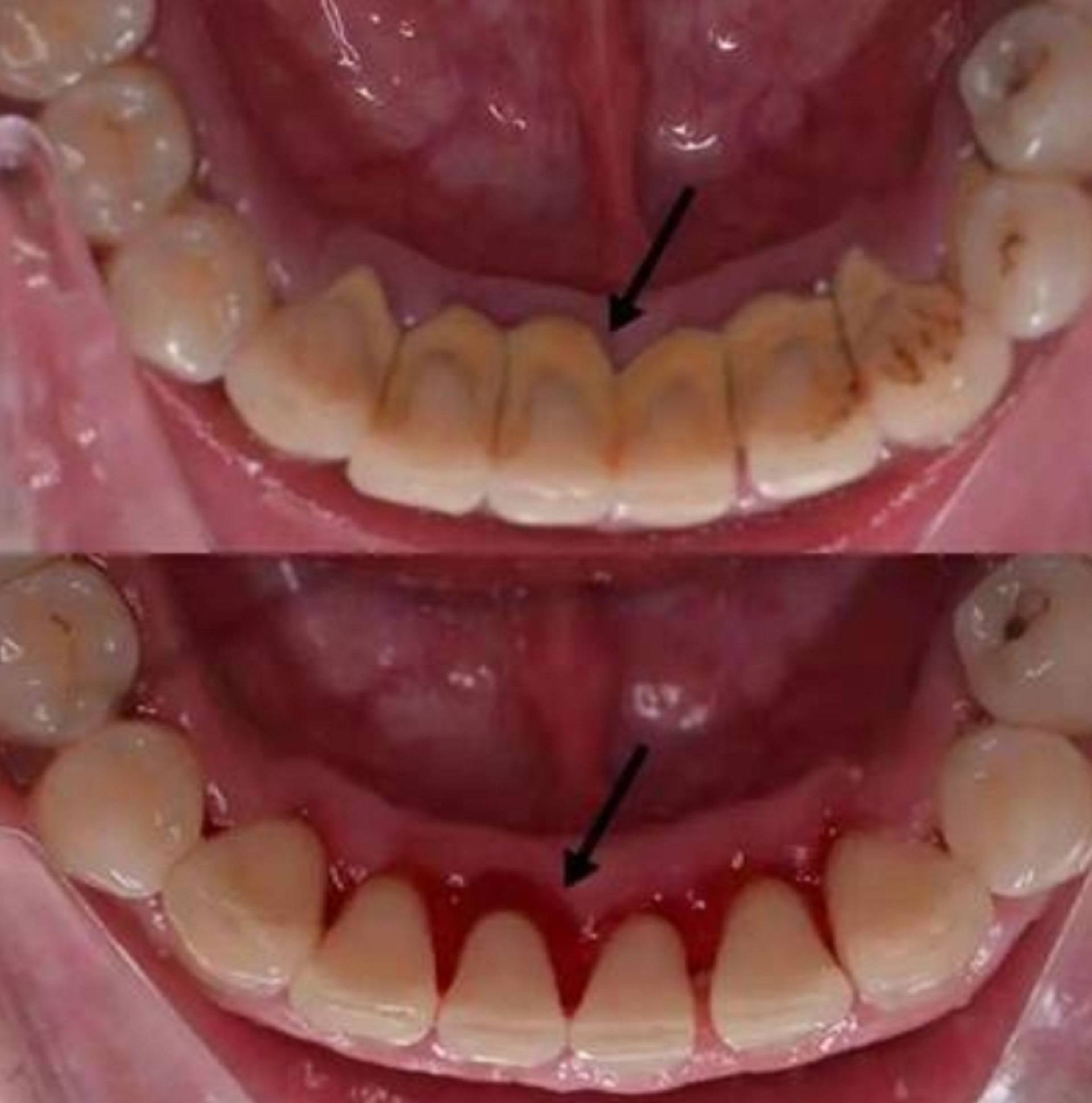 导致牙结石滋生别烦恼!每天三分钟刷掉牙结石!