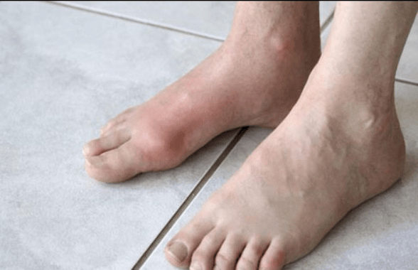 当我们人体的血管出现了堵塞,那么脚部的血液就会出现不通畅的症状