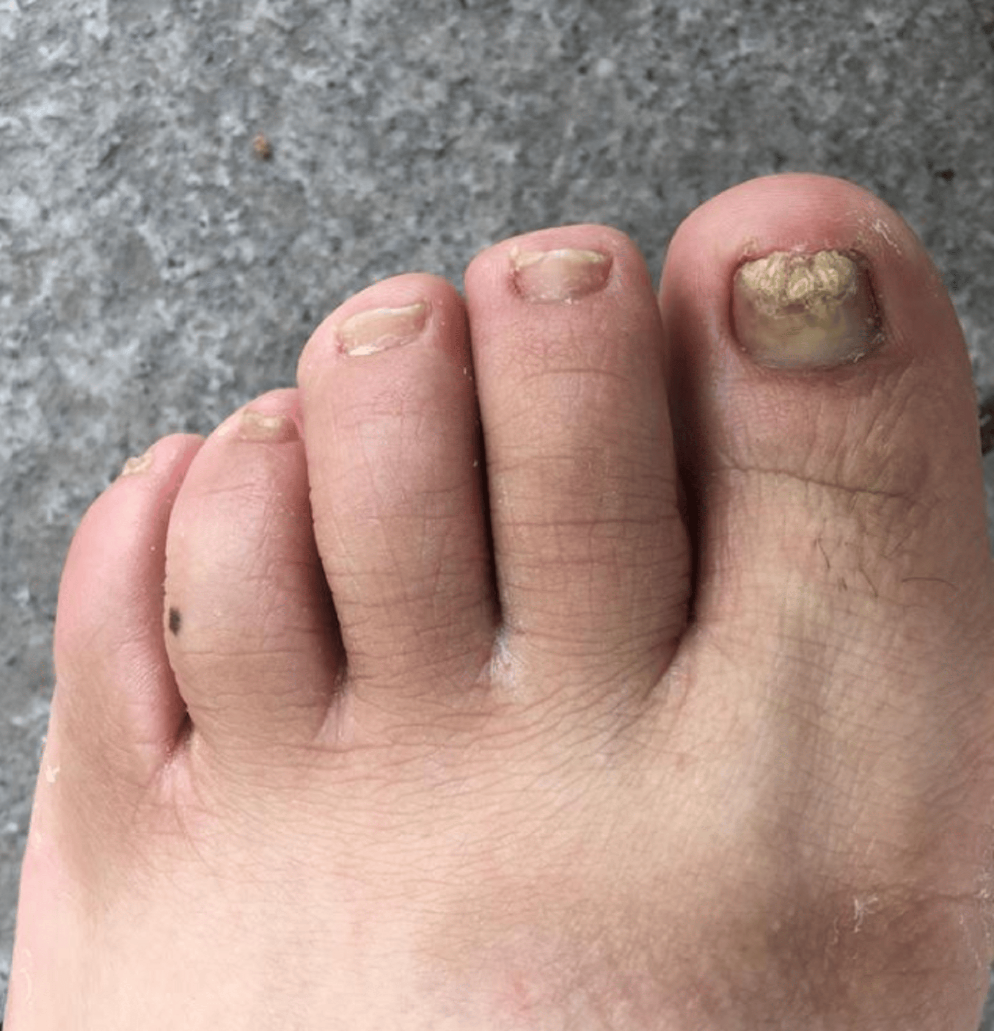 灰趾甲如何根治不反复!康复者自述经验,原来这3点才是关键!