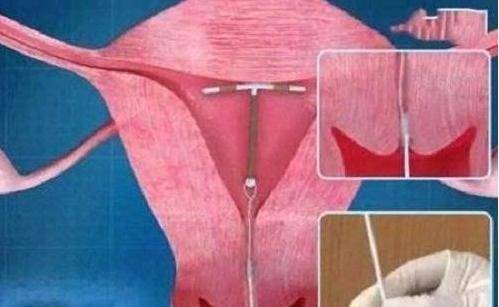 提醒:取环年龄尽量别超过这个岁数