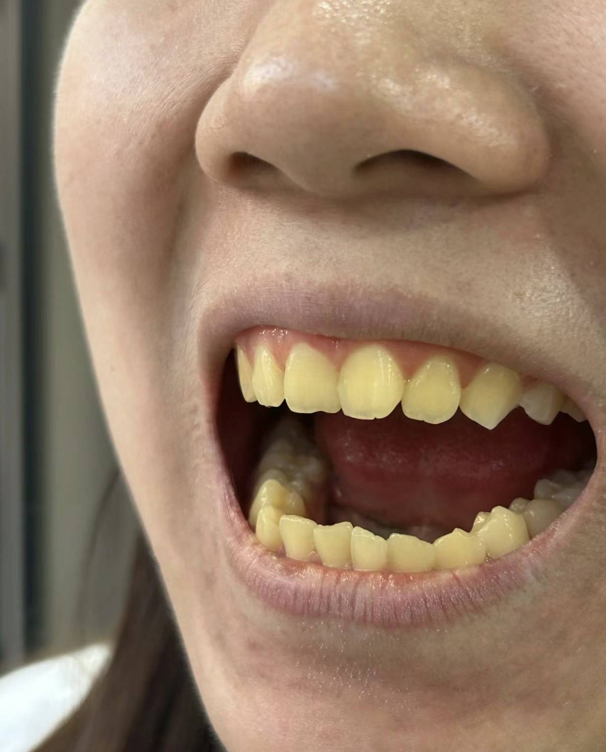 从小到大的黄牙也能刷白!真的要看!