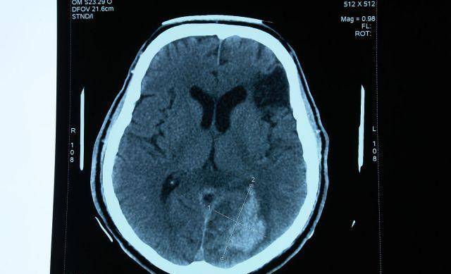 人到中年,头部有4种异常,或是脑梗来临前兆,早点查脑ct