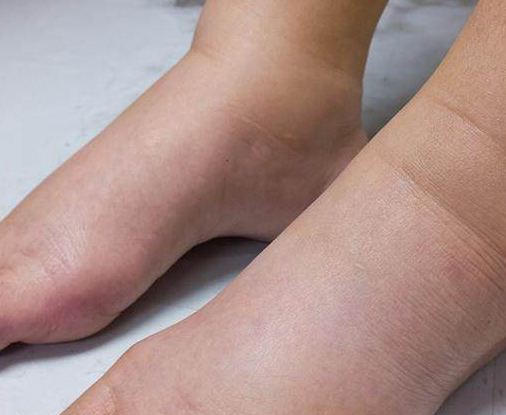 "肾"好不好看脚?若脚上没有这3个表现,恭喜,肾脏可能还不错