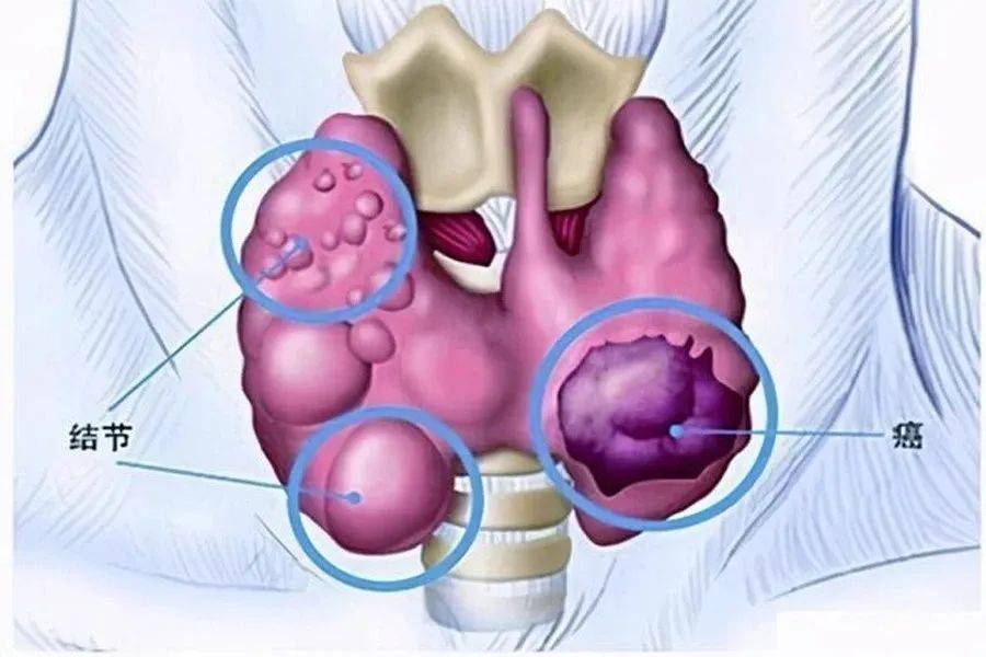 甲状腺测量示意图图片