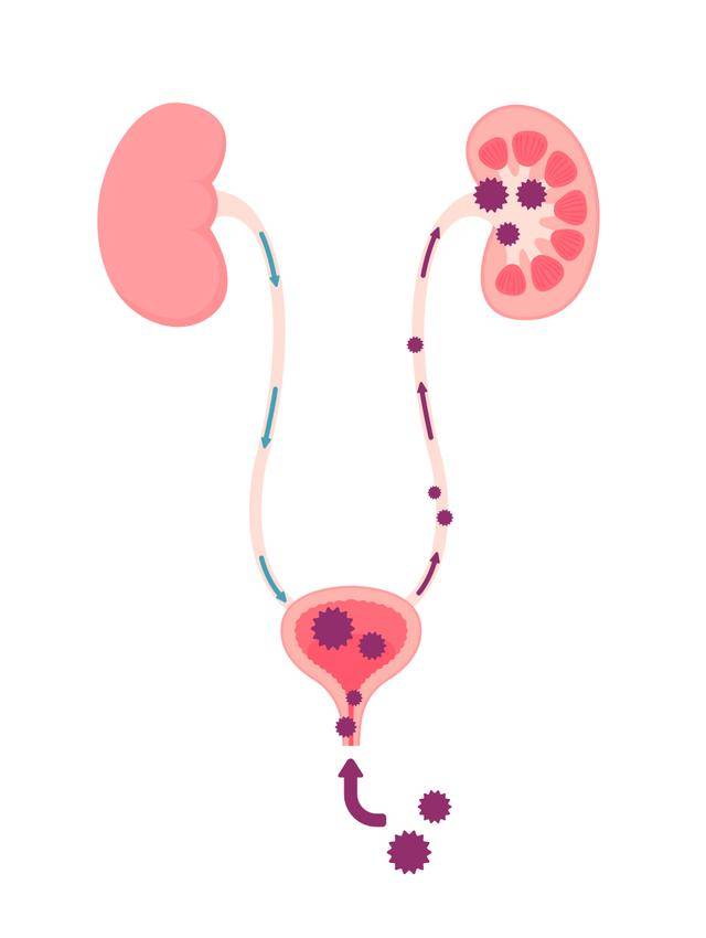 尿路感染反复发作?泌尿科专家来解答