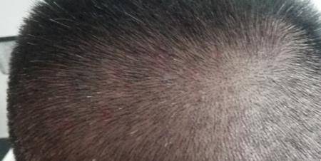 为什么头皮上长脓包和疙瘩?医生提醒:3种病要考虑在内