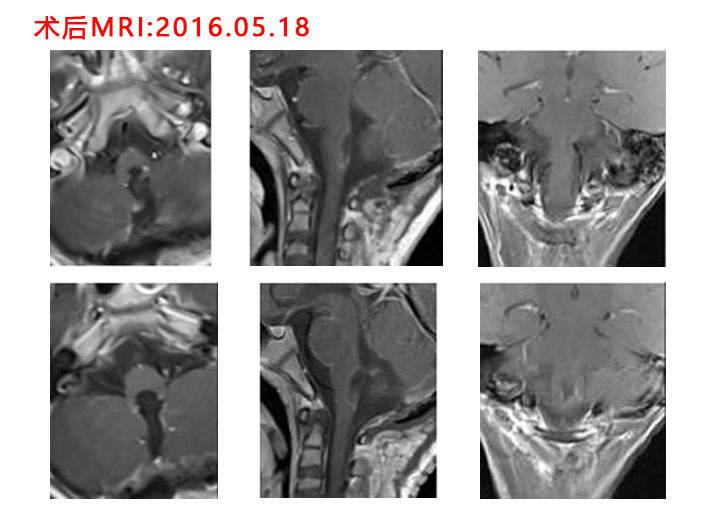 5岁小患者脑干恶性室管膜瘤切除术