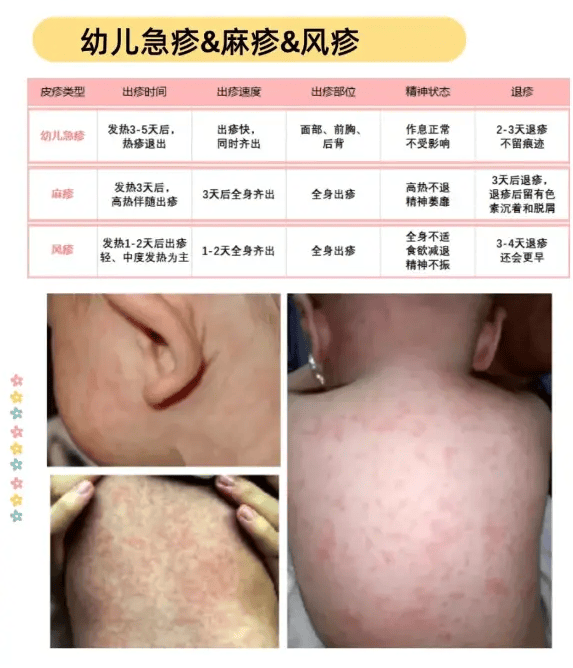 栗粒疹/痱子,急疹,风疹,水痘,荨麻疹,溢脂性皮炎