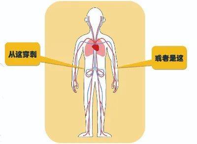 心脏支架图片位置图片