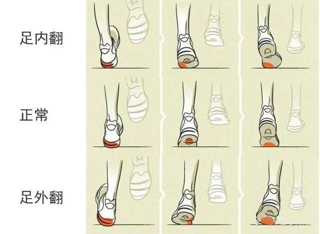 有疼痛感,足部柔软的平足孩子来说,选择足底较硬和鞋帮高于足踝的鞋子