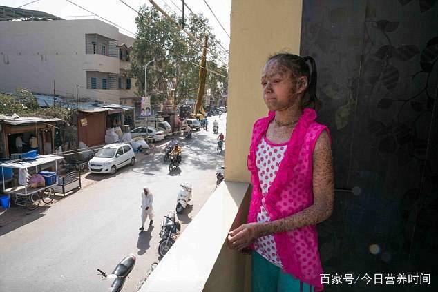 印度13岁少女患鱼鳞病成"蛇女",无法过正常生活,医生也无奈