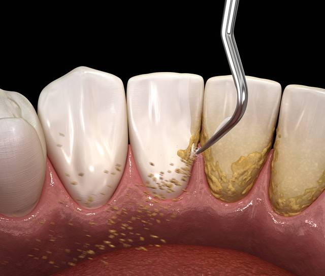 堆积成山的牙结石真的很烦!学会这些去石 白牙一步到位!