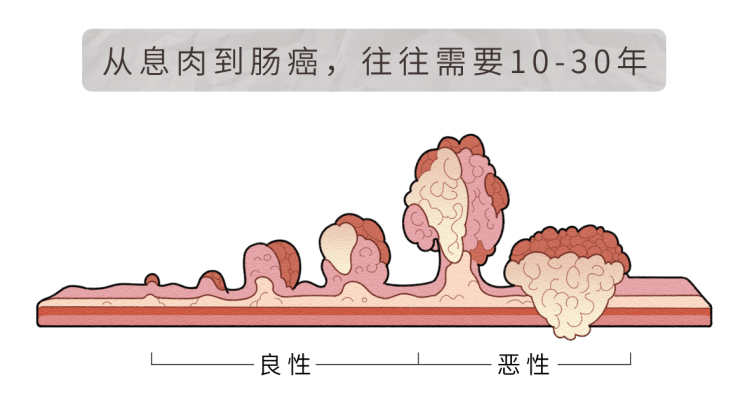 为什么肠癌发现就是中晚期(哪三多两痛警惕肠癌)