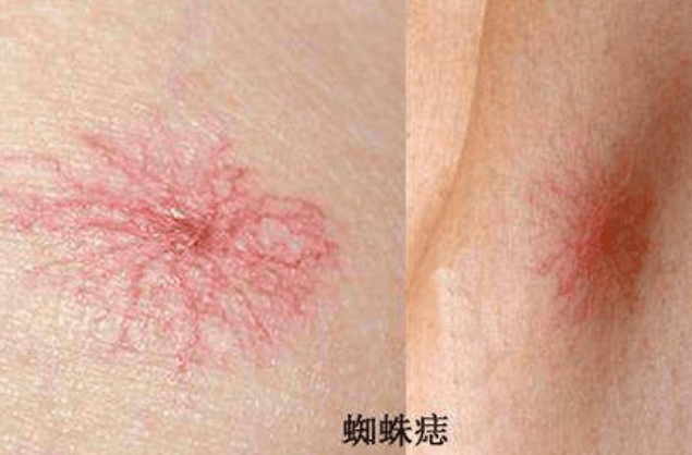 如果你发现你的前胸后背,以及脖颈处出现了很多蜘蛛痣,那么希望你要