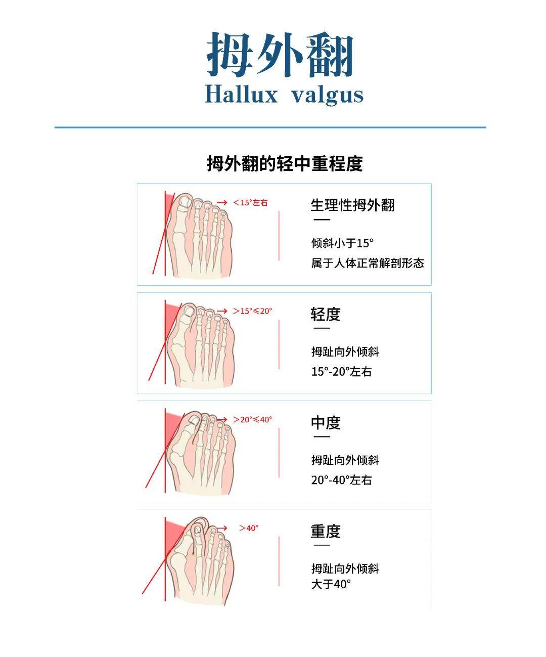 脚趾外翻怎么治疗图片