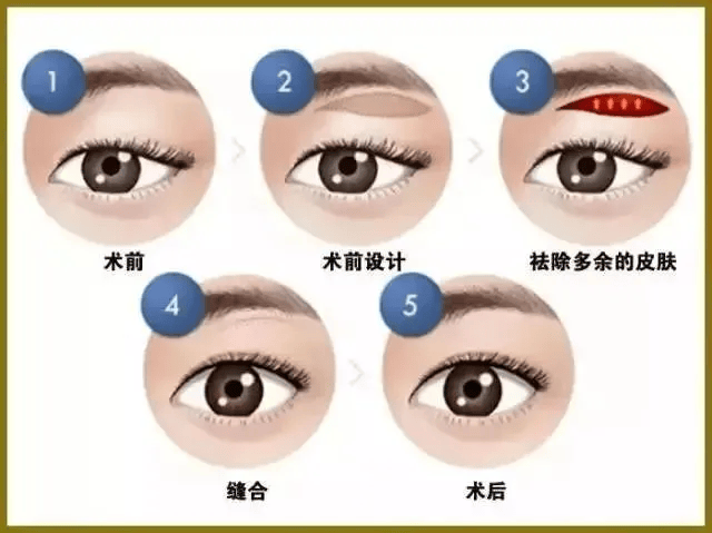 提眉vs切眉:切眉和提眉有啥区别,切眉和提眉哪个效果好?